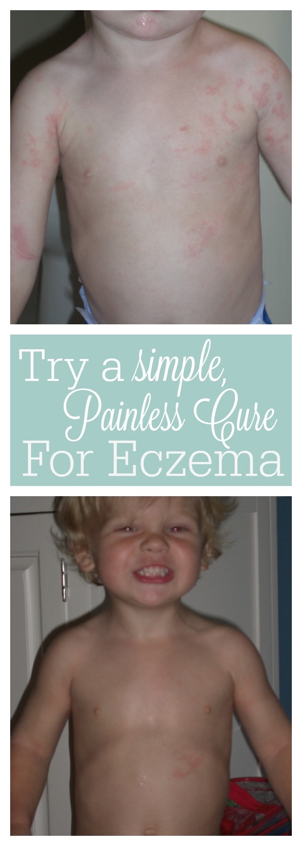 Eczema Painless Cure
